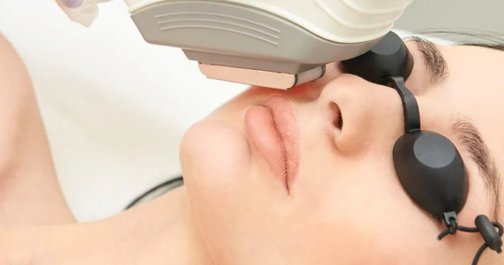 Customer receiving laser hair removal treatment wearing protective glasses for eye safety